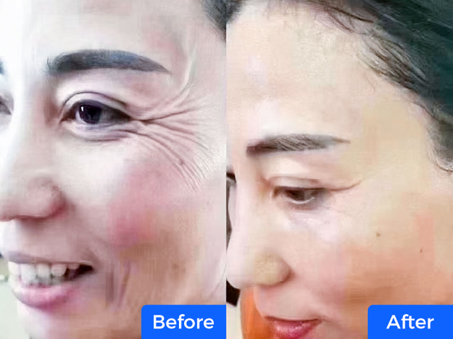 Removing wrinkles from the corners of the eyes
