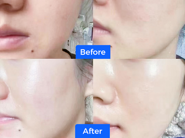 Facial hydration, whitening, and pore contraction